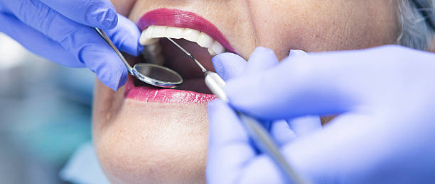 Best Knocked-Out Tooth (Avulsed Tooth) Treatment in Indian Springs, GA
